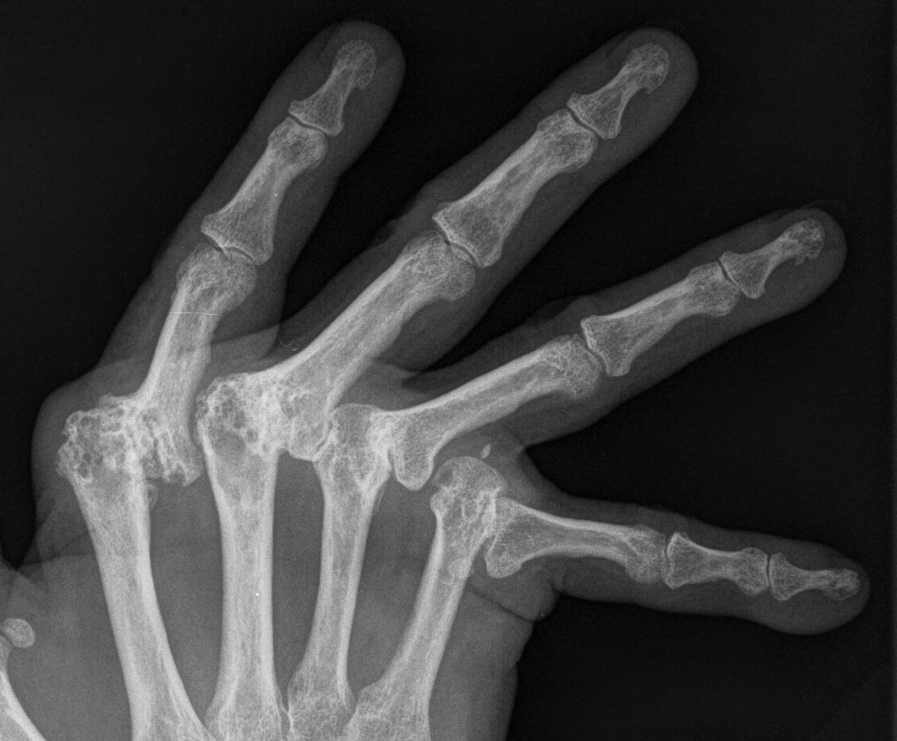 Rheumatoid MCPJ Ulnar Deviation